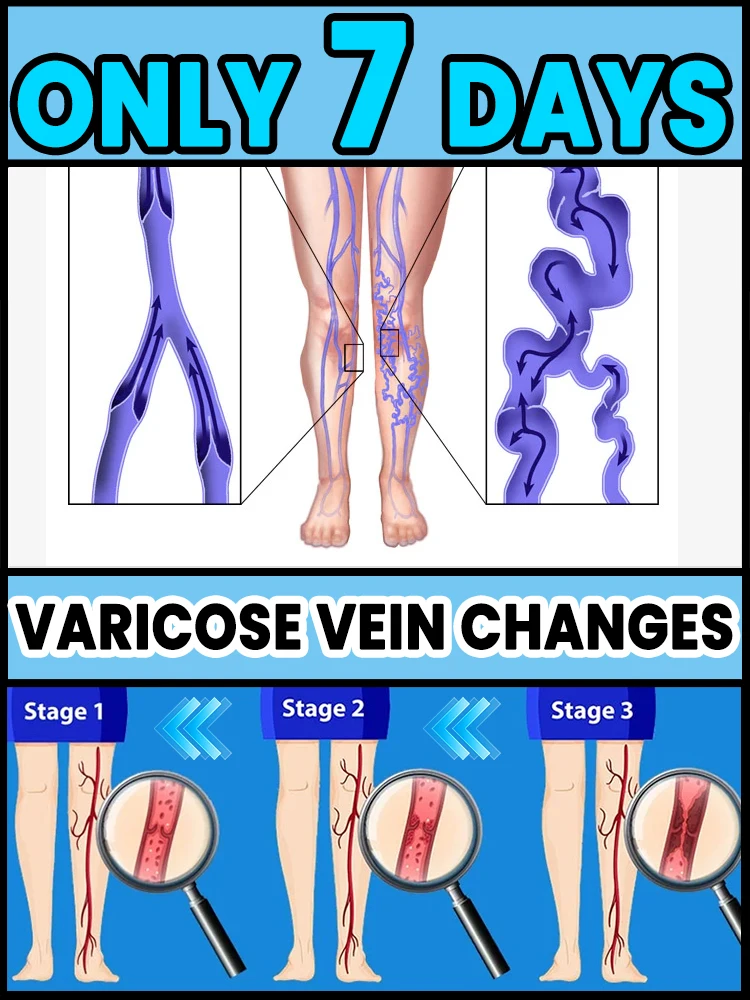 

Blue light pen therapy, reduces pain, promotes blood circulation, relieves varicose veins