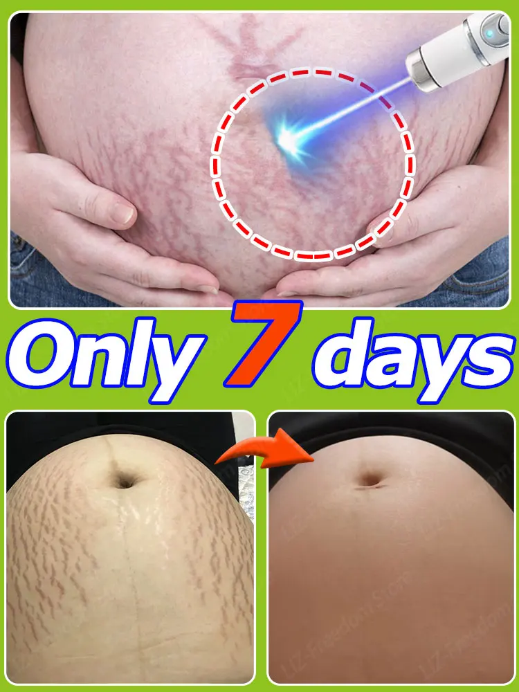 

Gentle Skin Care Improves Elasticity Effective After Pregnancy Stretch Marks Maternity Cream