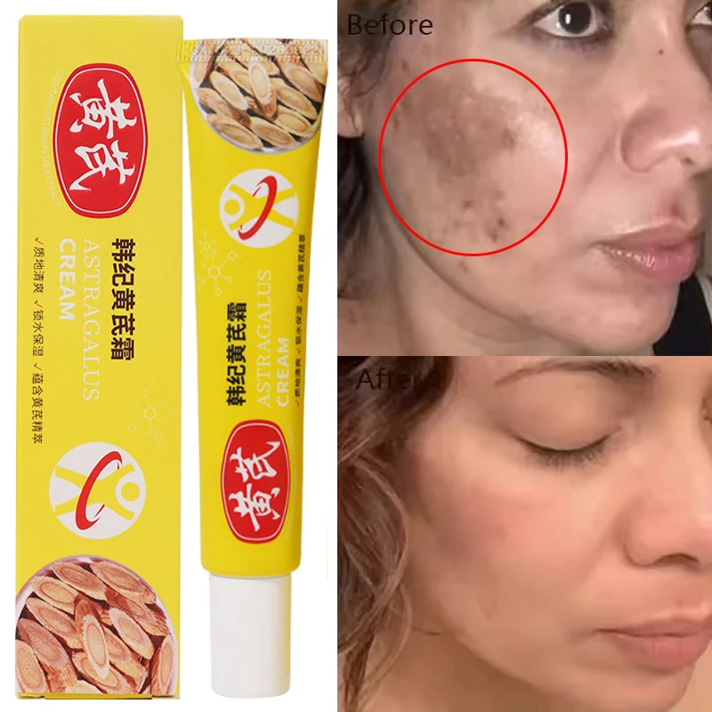 

Astragalus Whitening Freckles Face Cream Dark Spots Remover Products Removal Melasma Melanin Moisturizing Brighten Skin Care