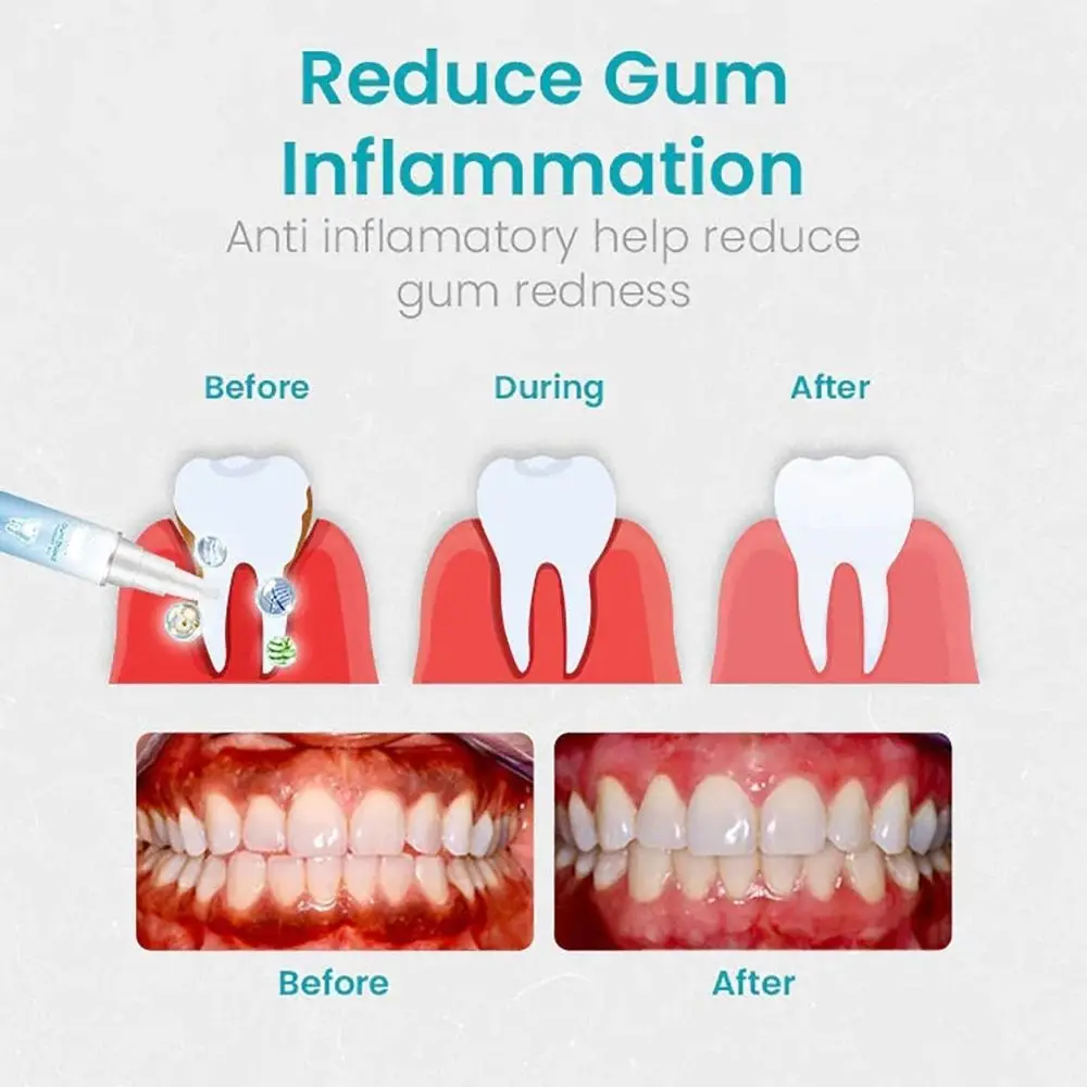 Oral Care Gum Treatment Gel Dental Repair Reduces Inflammation Gum Shield Therapy Gel Easy to Use Reduces Discomfort