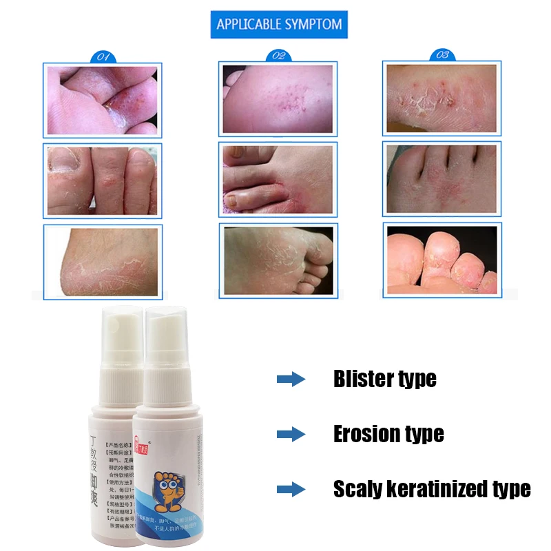 Foot Spray Relieve Foot Odor Beriberl Itching Foot Fungus Infection Dressing Bacteriostatic Spray Foot Repair Product Liquid