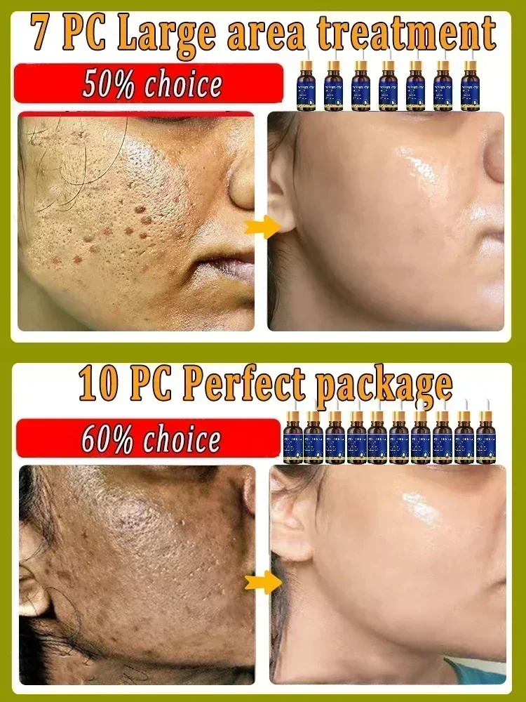 Acidez Poro Encolher Soro Rosto, Remover Cravos, Acne, Controle de Óleo, Reparação Essência, Hidratante, Nutrir Poros Refirmando, Cuidado Facial