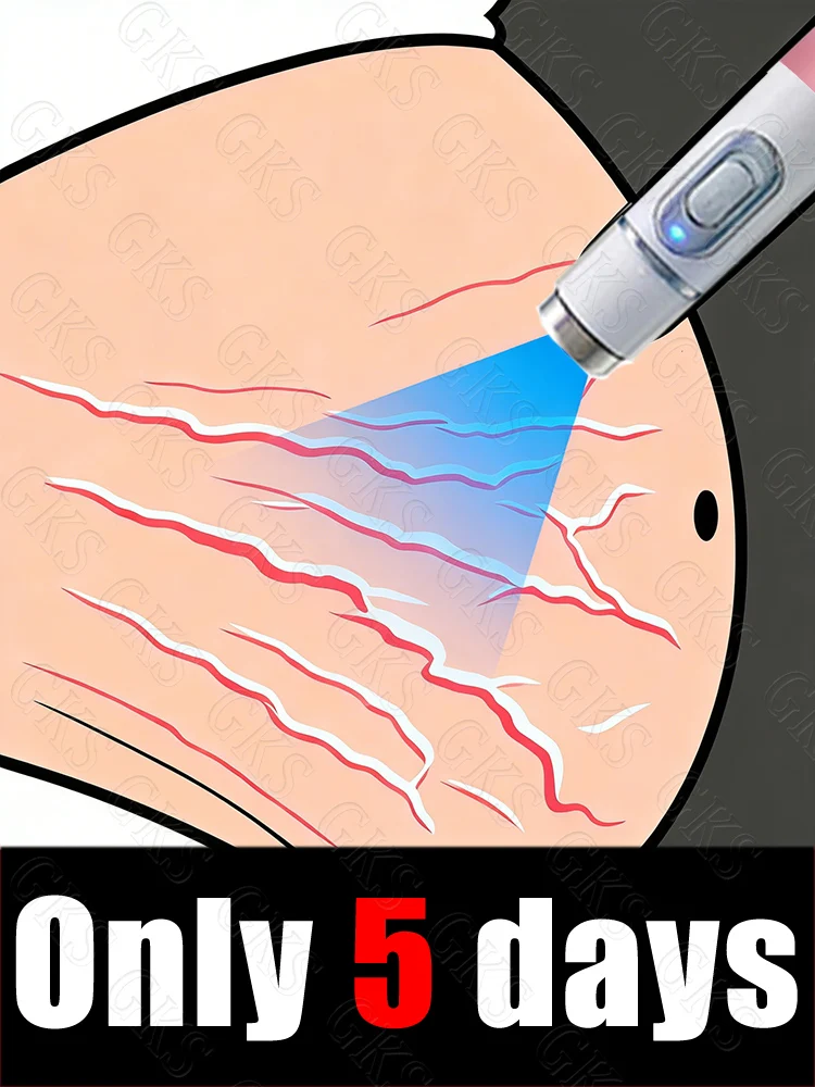 

Портативный лазерный указатель для уменьшения растяжек и улучшения состояния кожи