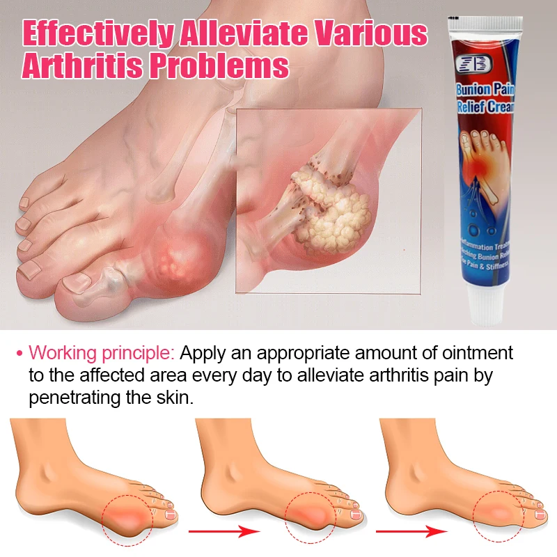 20g/pcs Thumb inflammation gout ointment is used to treat thumb inflammation, relieve itching and pain, and reduce inflammation