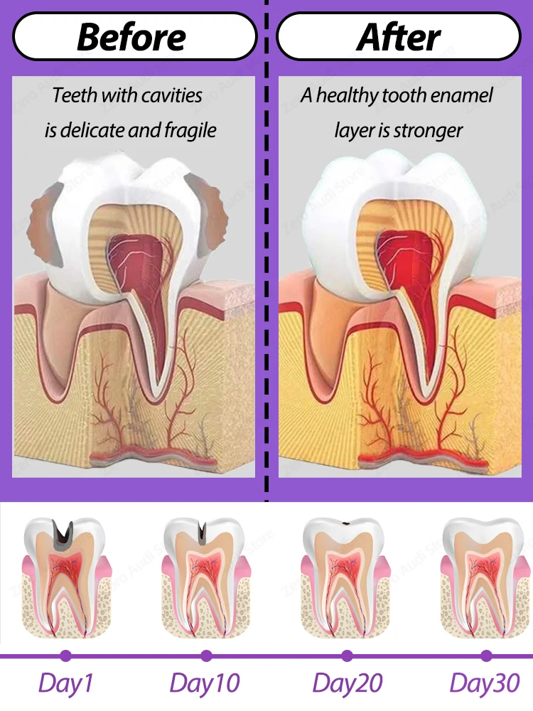 Tooth decay Repair Repairing Cavities Anti Protecting Caries