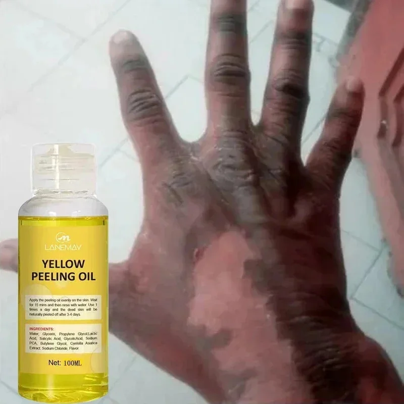 Yellow Peeling Oil 100% Organic Whitening Bleaching Dark Skin Serum Dark Knuckles Fast Whitening Body Care Korean Cosmetics