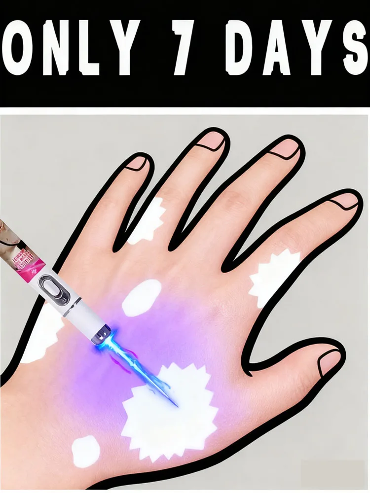 白斑を7日で除去