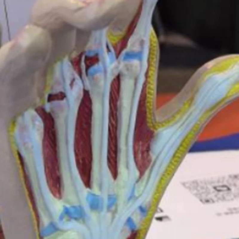 Osteoarthritis Hand Model, Model Of Hand Pathology, Human Anatomy And Physiology Replica, 's Office Anatomy Model