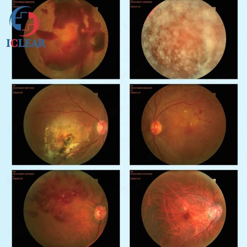 China 3D Hr Digital Automatic Non-Mydriatic Fundus Camera with FFA/FAF