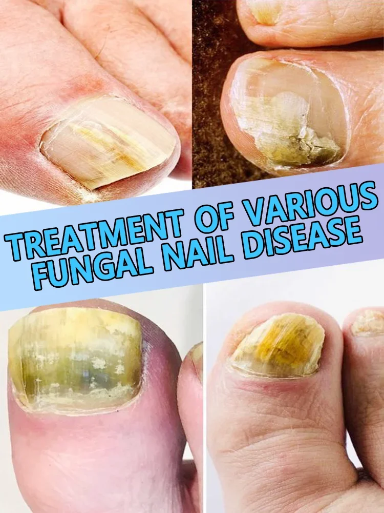 Laser treatment devices for treating onychomycosis, fungal infections, and various foot problems