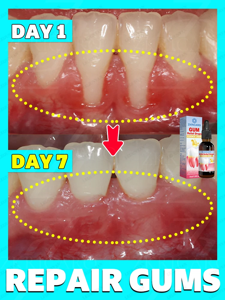 Quick and effective gum restoration