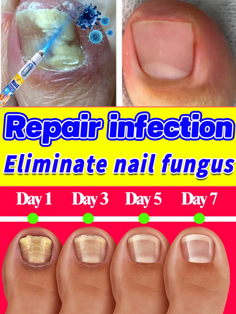 

A trusted remedy for onychomycosis, this product will make your nails healthier.