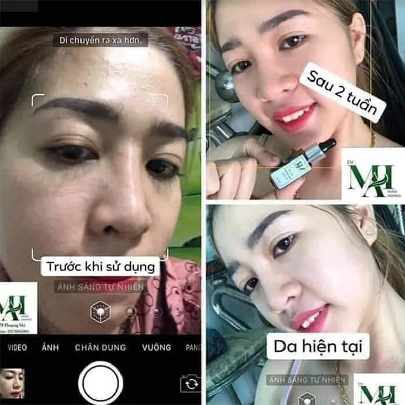 ماي ثيا خور دكتور ماي نوكواد 5 مل لعبة الخنزير المهام الشوك تشو دا نغلق كسه تشيسين هانغ، مزيل حب الشباب، البشرة الحساسة المناسبة