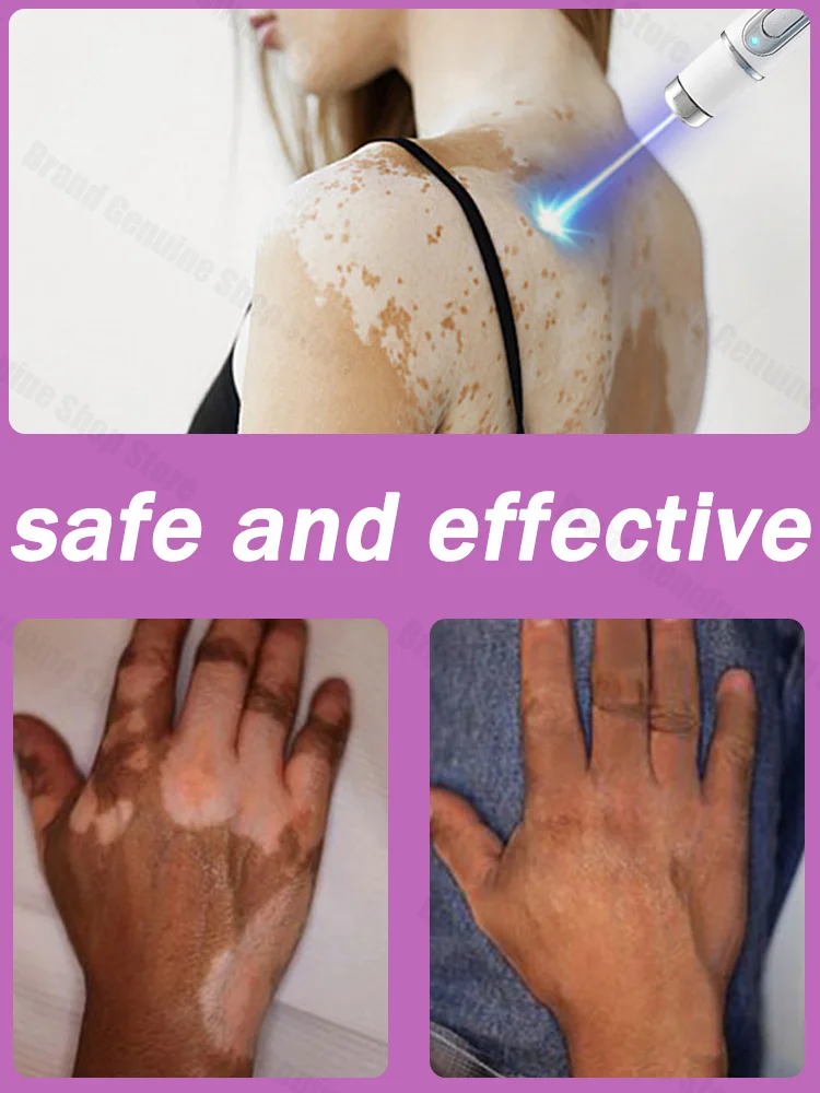 

Vitiligo laser treatment pen for men and women