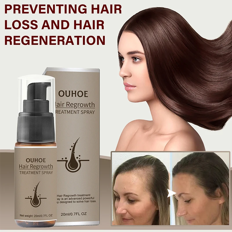 Productos en aerosol para el crecimiento rápido del cabello, suero anticaída para prevenir la calvicie, tratamiento del cuero cabelludo, aceite esencial seco y dañado, belleza del cabello