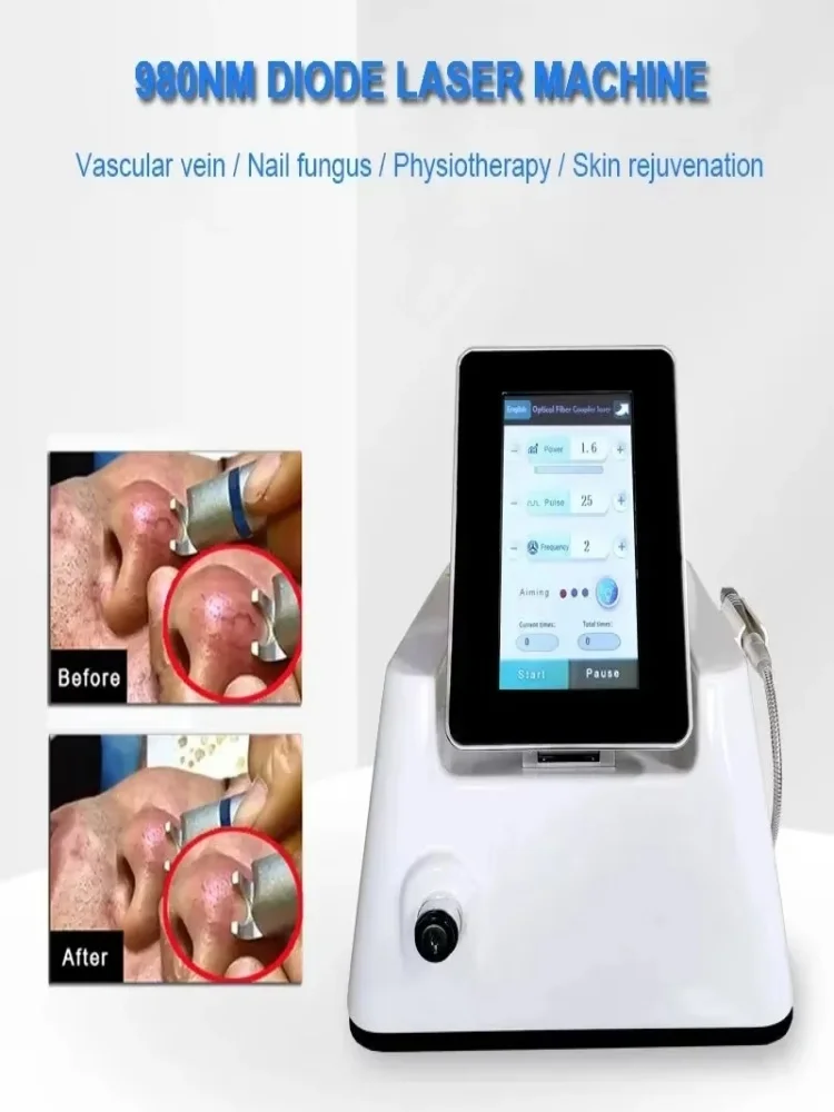 Dispositif de traitement des champignons des ongles, élimination des veines d'araignée, diode laser, onychomycose, veine vasculaire, diode laser, 980nm, approuvé CE, 5 en 1