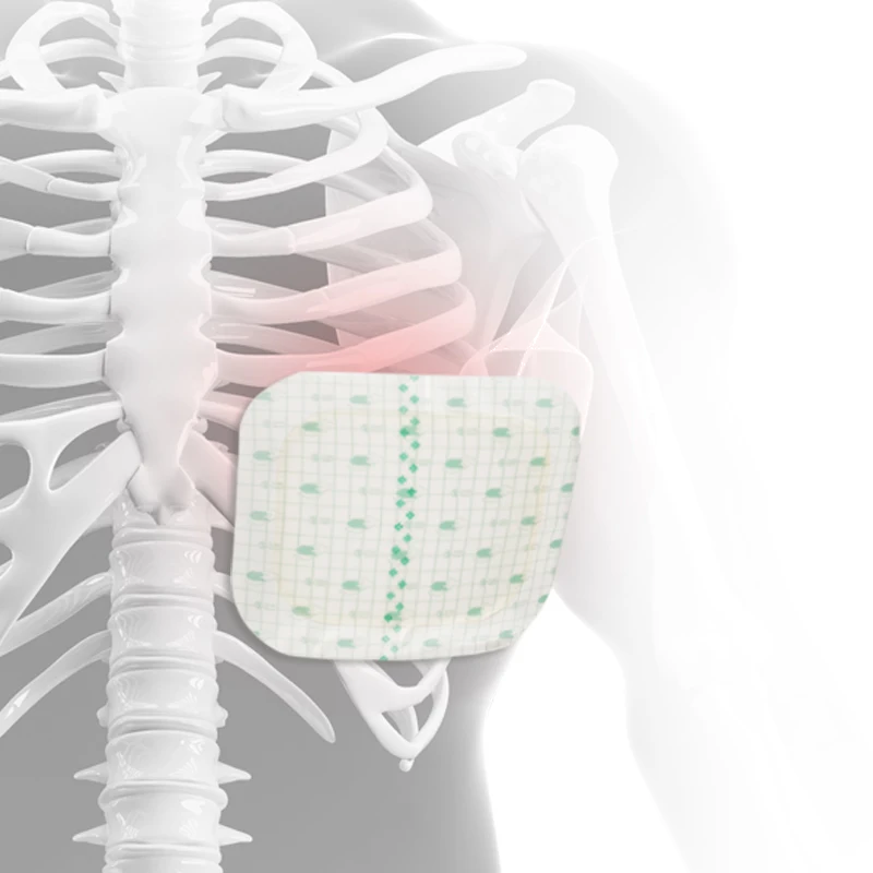 Functional Splint Rib Fixed Splint
