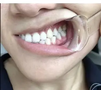 

Стоматологический Т-образный ретрактор для щек, открывалка для губ и рта для полости рта, уход за клиникой, ортодонтические процедуры, профессиональный стоматологический инструмент