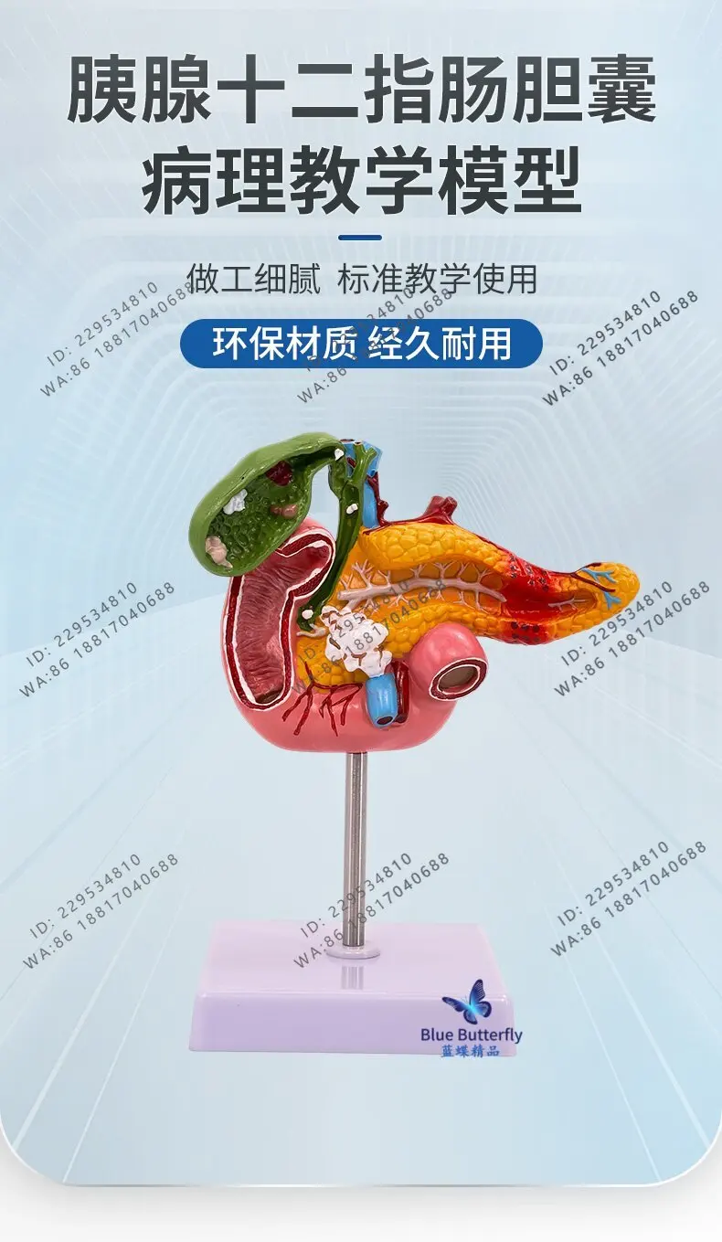 Medical pancreas duodenal gallbladder pathological model, hepatobiliary model