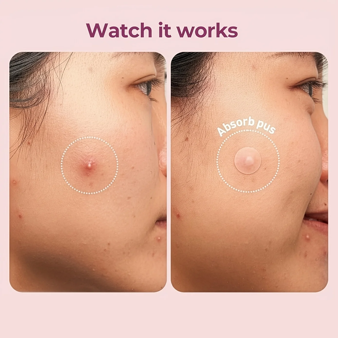 321/609PCS Hydrocolloid Acne Patch | Blemish Coverage | Suitable for Daily Facial Care and Pre-Cosmetic Use image 6