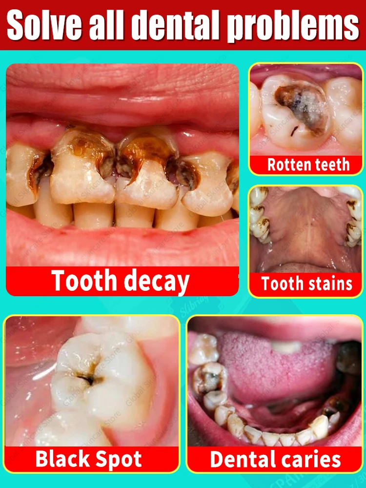 

tooh Decay repair