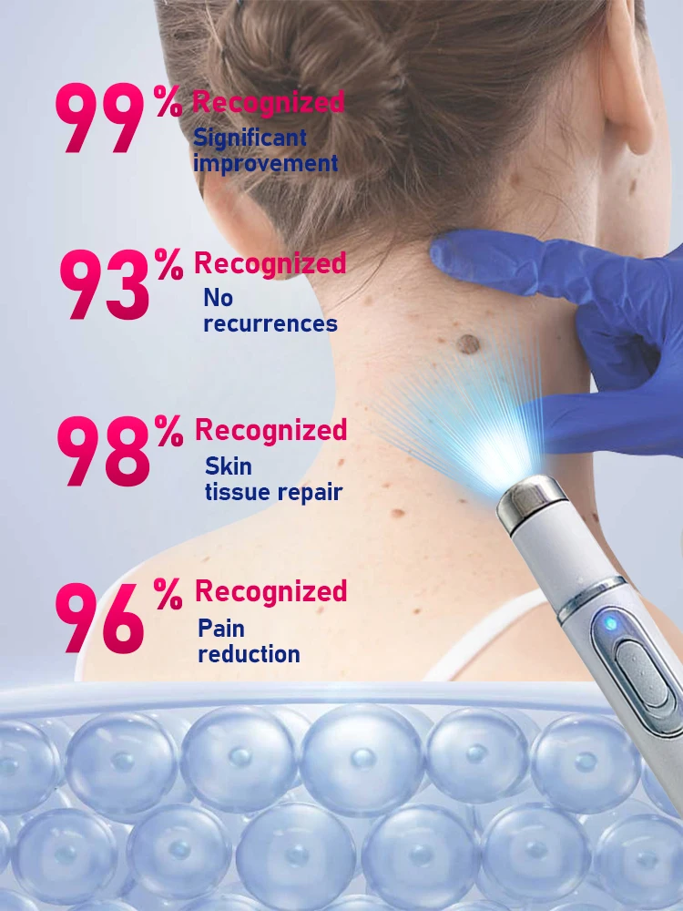 La Generation-2 Laser dit au revoir aux verrues supprimer سريع #3