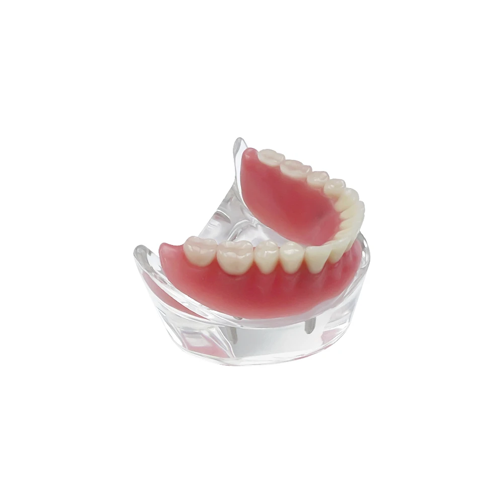 With 4 Implants Overdenture Restoration Model Upper/Lower jaw Teeth Model For Dentist Patient Teaching Typodont Demo Model