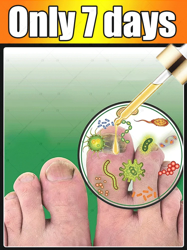

Say goodbye to onychomycosis, no recurrence, no damage to nails.