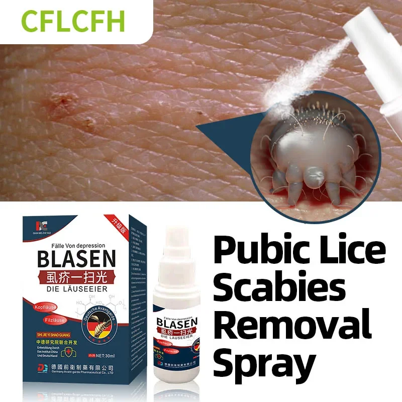 

Pubic Lice Scabies Mites Removal Treatment Spray Head Lice Eggs Remover Antibacterial Anti-Itching Medicine German Secret Recipe