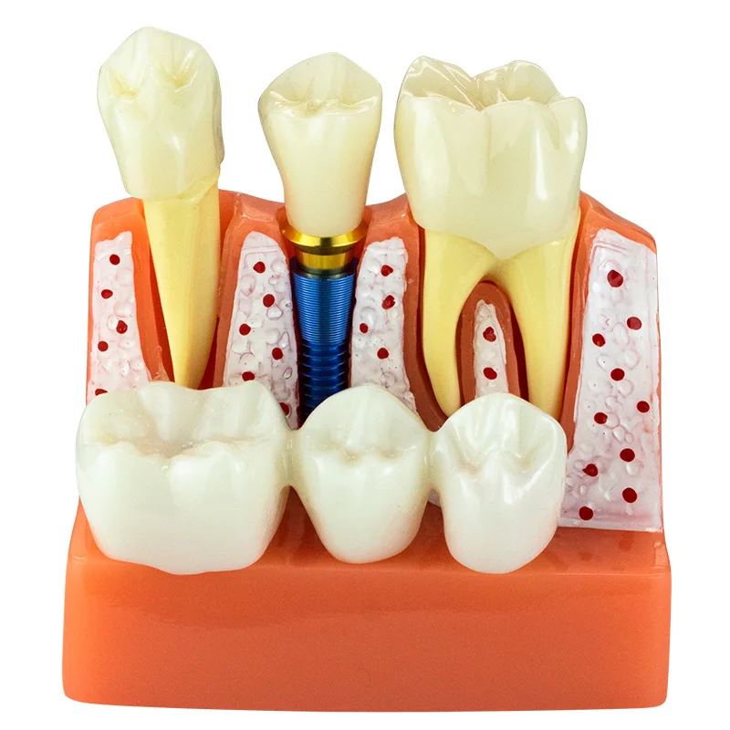 4 Times Dental Teach Implant Analysis Crown Bridge Removable Model Dental Demonstration Model Dentist Study Teaching Model