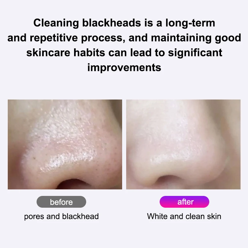 VLVEE Elektrische Comedondrukker Gezichtsreinigingsmachine Pore Cleanser Handheld Mee-eter & Acne Remover huidverzorging Tool