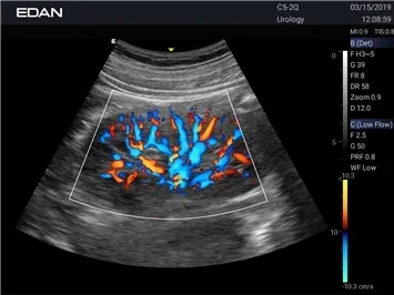 Échographie couleur portable Edan Acclarix AX3 avec transducteur convexe Échographie linéaire pour clinique humaine et vétérinaire