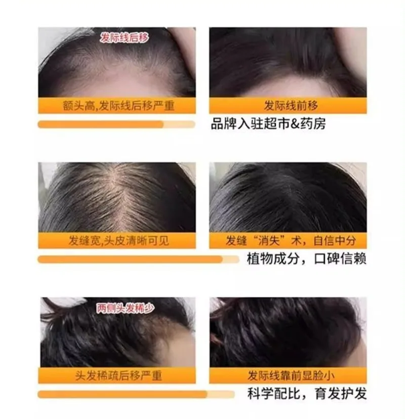 Hair Loss Prevention & Scalp Care Shampoo - Controls Oil, Adds Volume & Supports Healthy Hair Growth,Dermatologically Tested