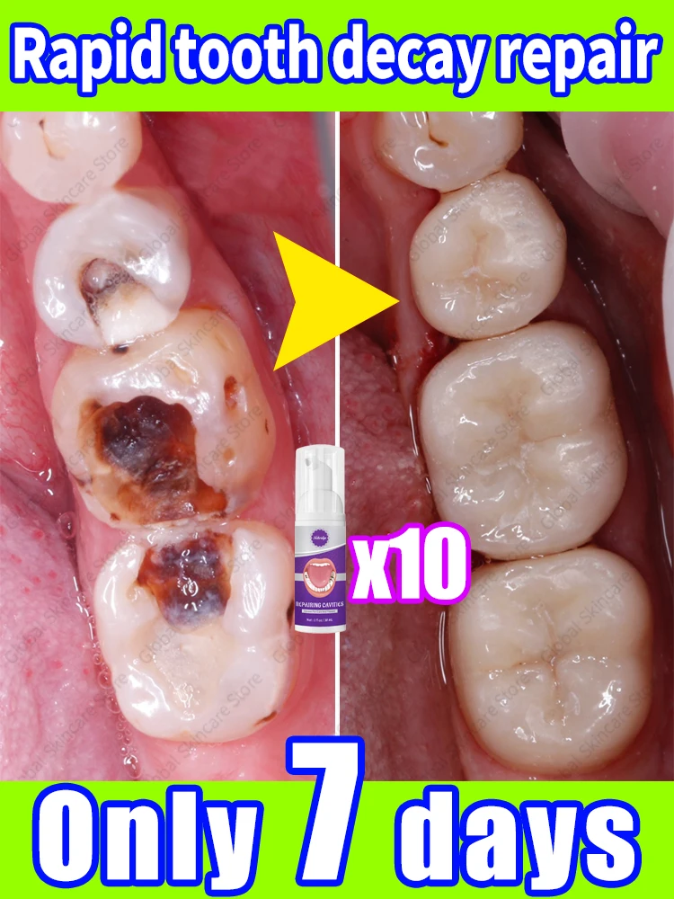 

tooh Decay repair