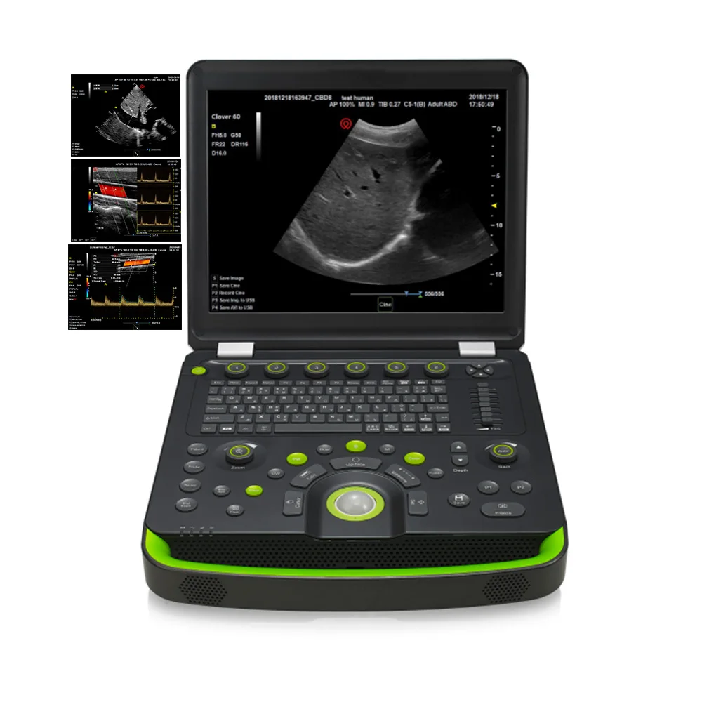 medical Color Doppler Adult heart Carotid artery portable Vascular Cardiac Ultrasound machine laptop with battery & travel case