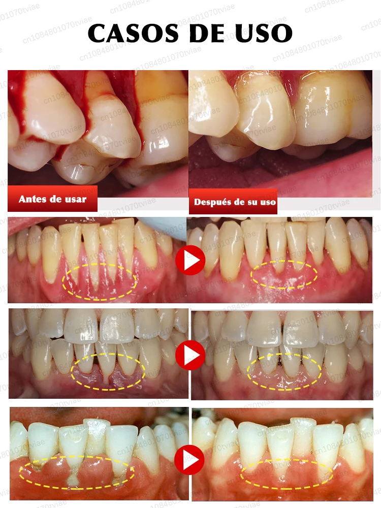 Proteja a saúde das gengivas, alivia rapidamente a dor de dente, repara gengivas danificadas e elimina o sangramento das gengivas