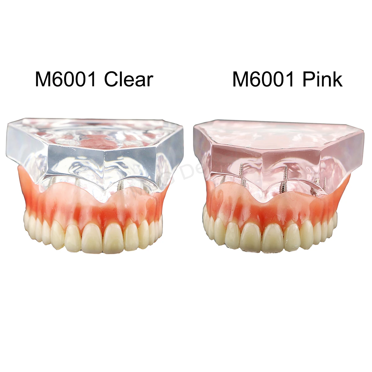 Dental Teeth Model Implant with Overdenture Restoration Removable Bridge Demo Dental Education Model  for Tooth Teaching Study