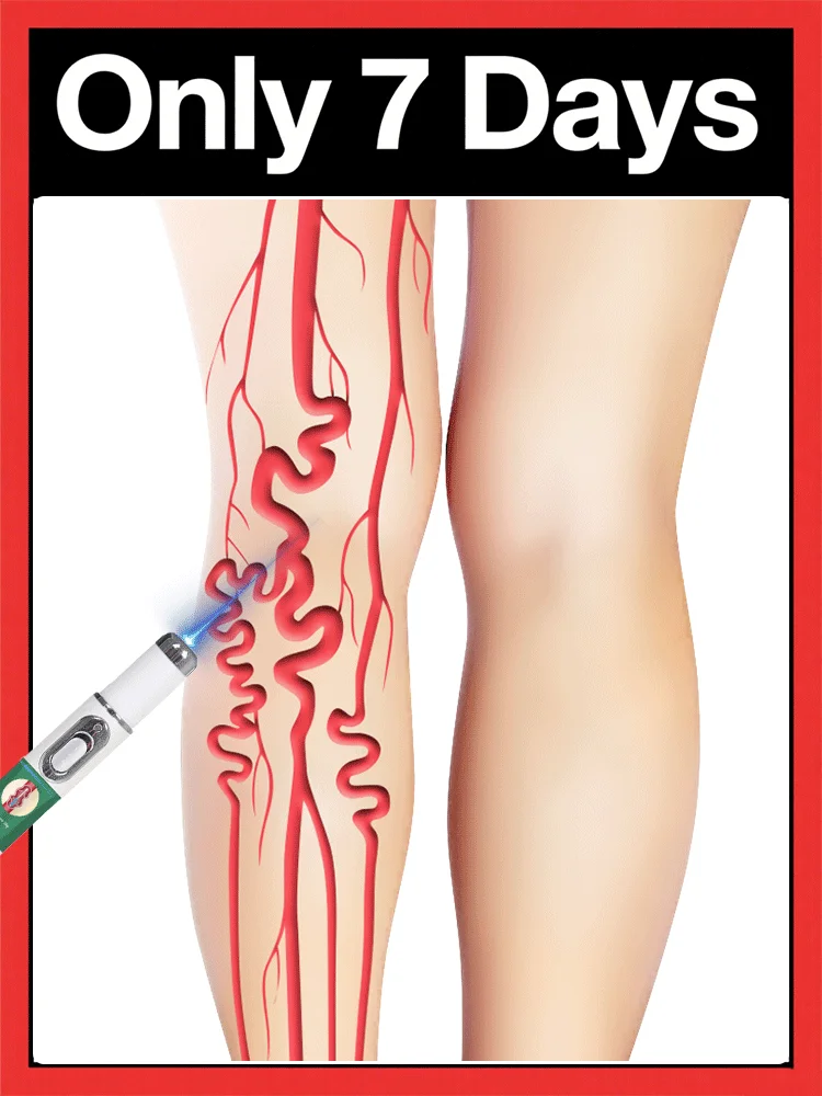 Strumenti per la cura delle gambe Penna per vene varicose