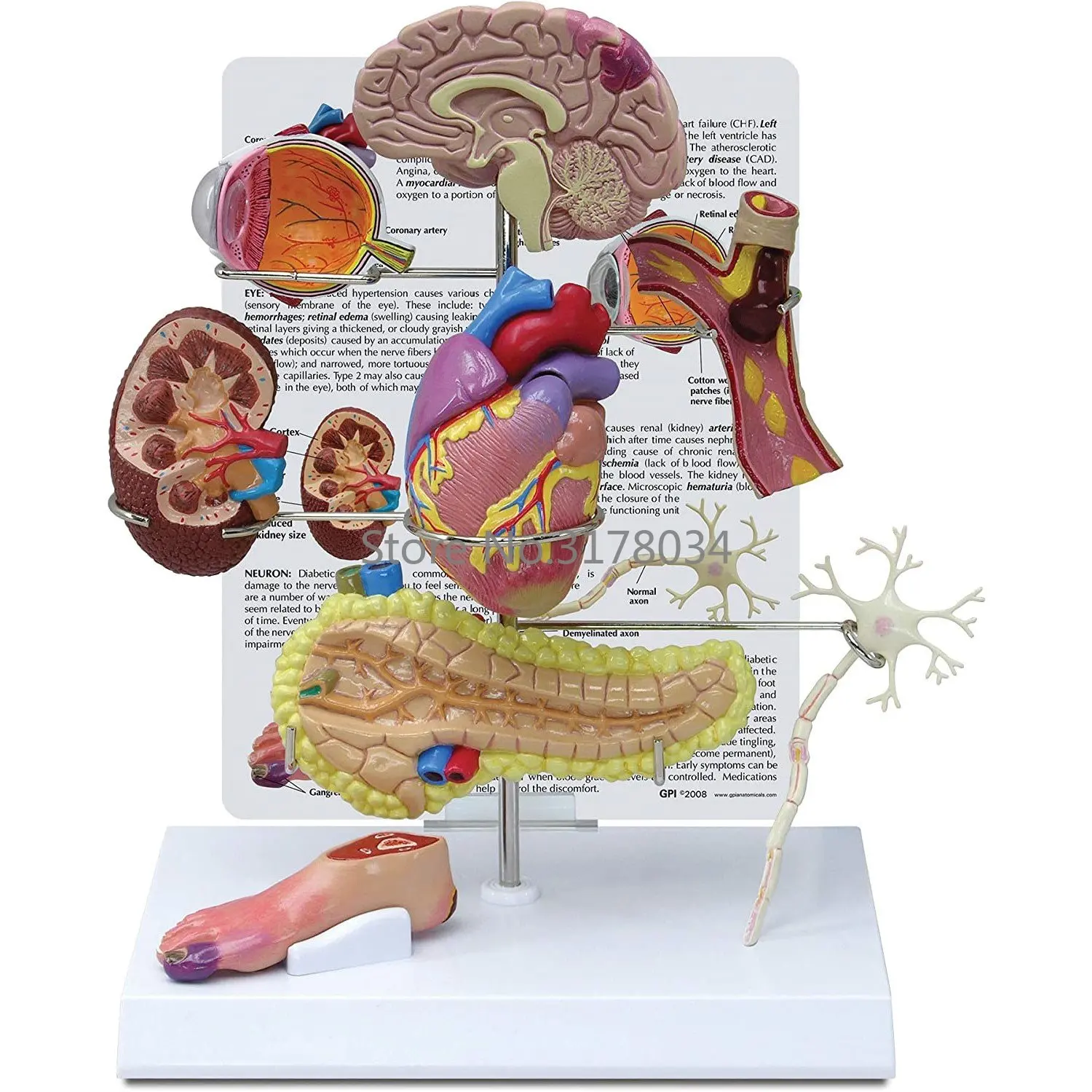 

Diabetes Model Set Human Body Anatomy Replica of The Effects from Type II Diabetes for Doctors Office Educational Tool