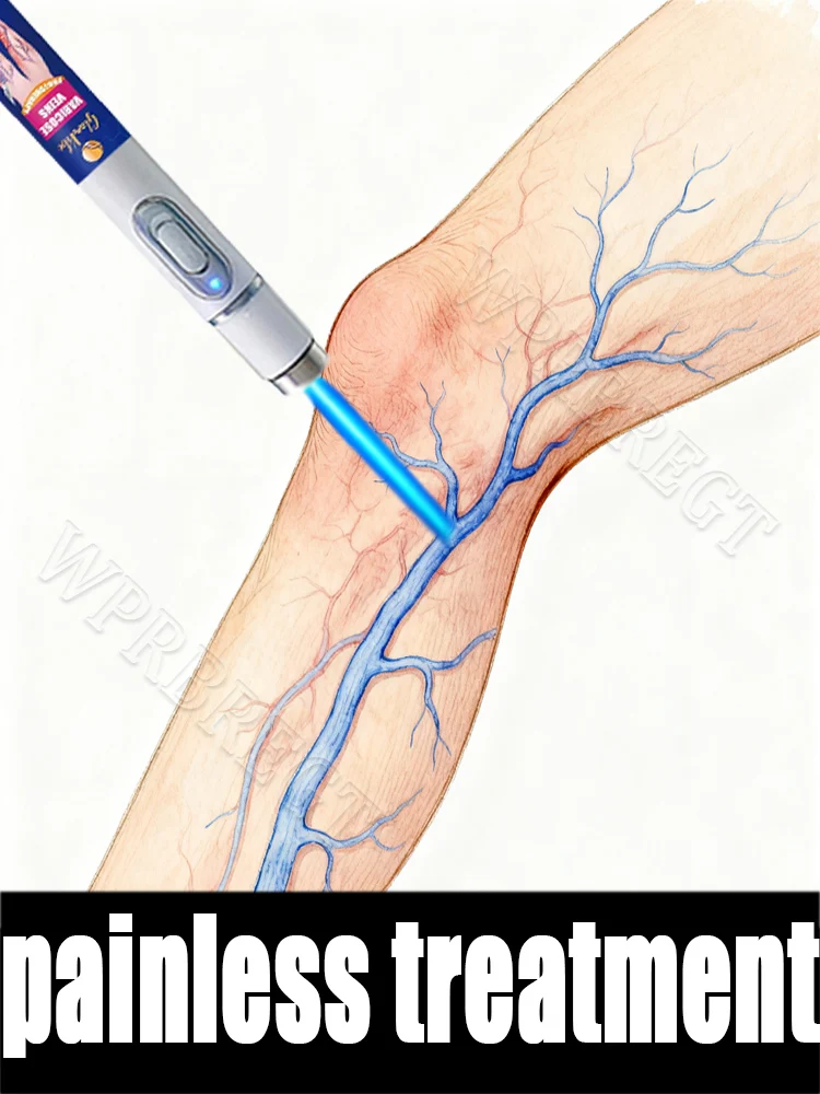 

Laser treatment to clear blocked veins