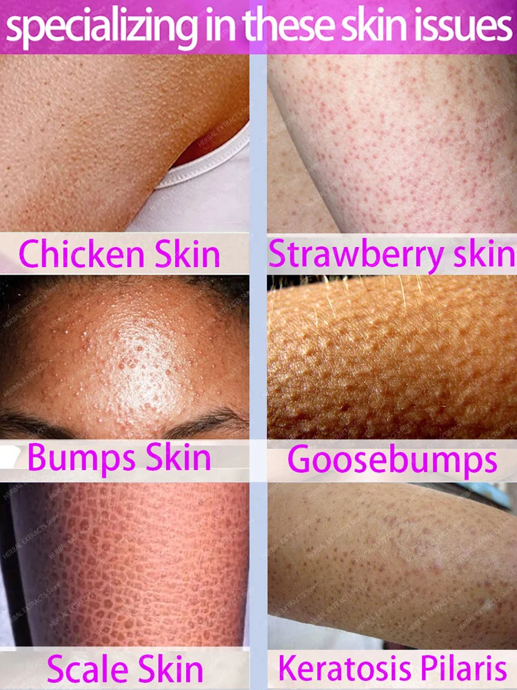 Keratosis Pilaris Cream  Rough Goosebumps Tiny Bumps Red Bumpy Chicken Skin Removal