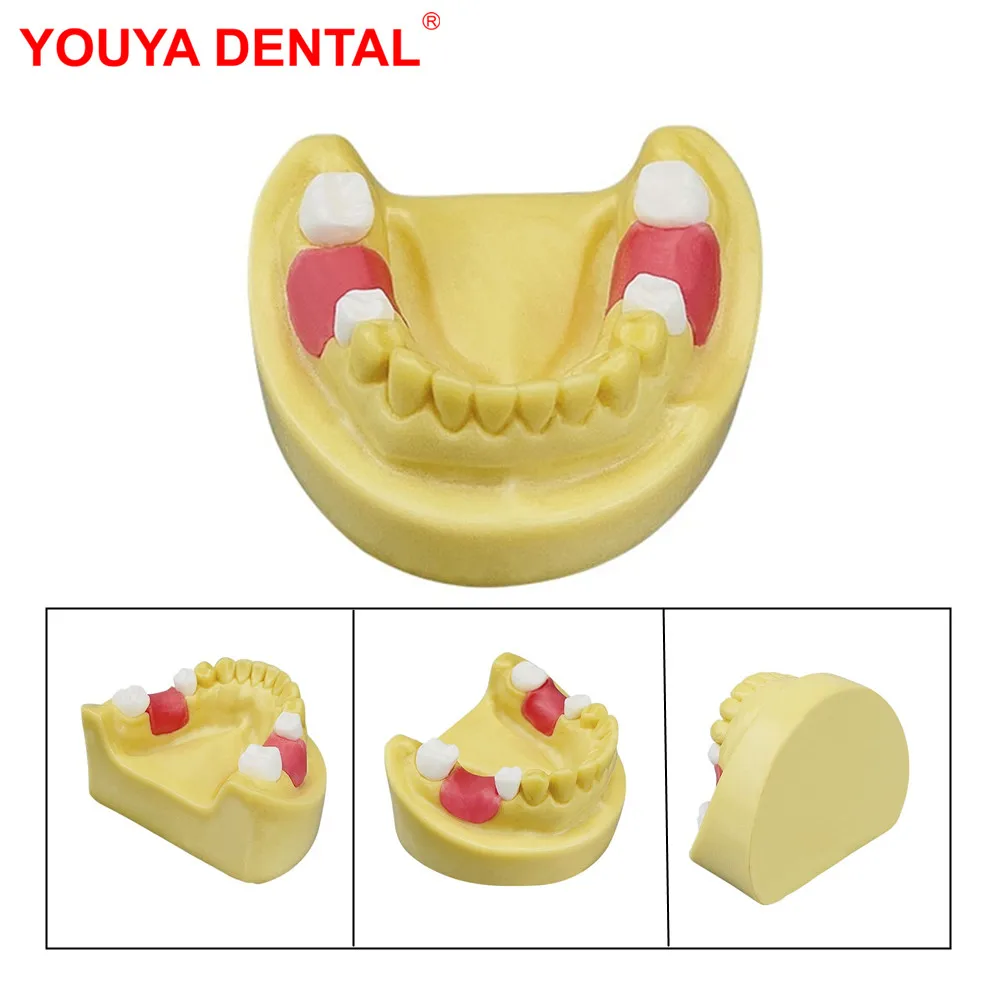 

1pc Lower Jaw Teeth Model Dental Practice Model Implant Model Missing Tooth For Training Studying Education Teaching Display New