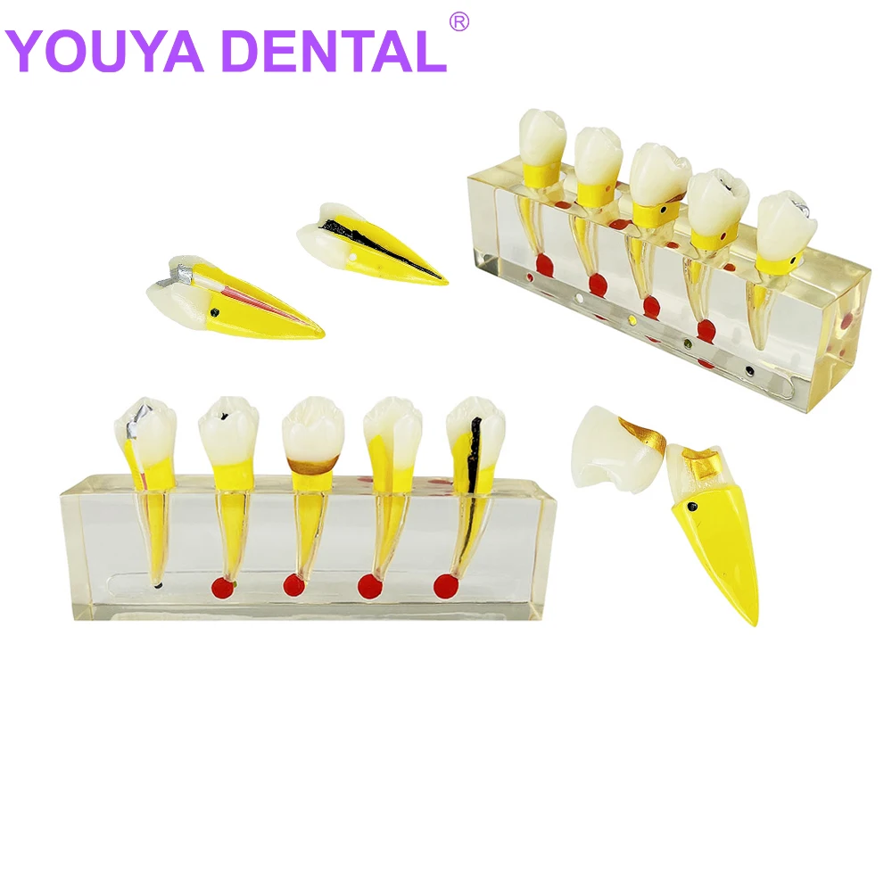 

Dental Endodontic Pathological Teeth Model Teeth Pulp Cavity Model For Dentist Pathology Patient Communication Demonstration Too