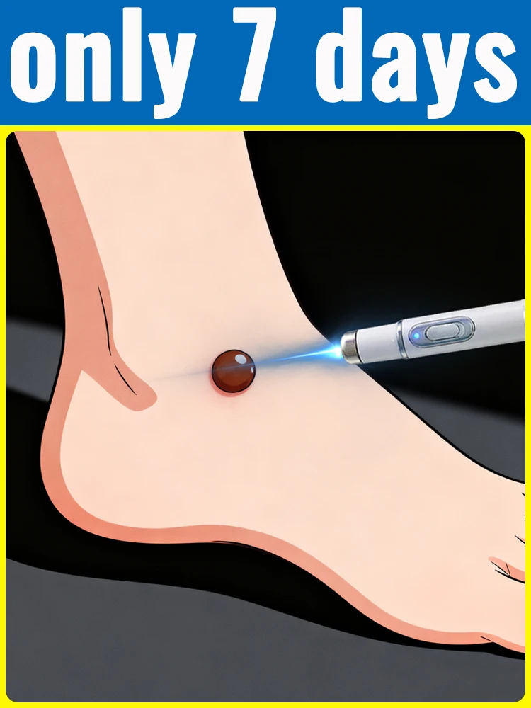 

Модернизированные бородавки 2-го поколения Безболезненный ремонт корня бородавок uickly