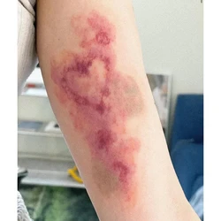 Heart Bruise Fake Tattoo for Woman Man Arm Art Scar Blood Stasis Temporary Tattoos Waterproof Tatuajes Temporales Cosplay