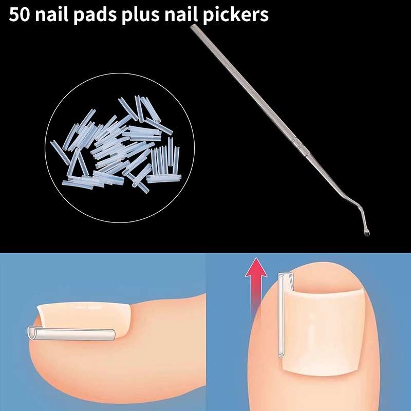 50Pcs Ingrown Toenail Correction Tool Ingrown Toe Nail Treatment Elastic Patch Sticker Straightening Clip Brace Pedicure Tool