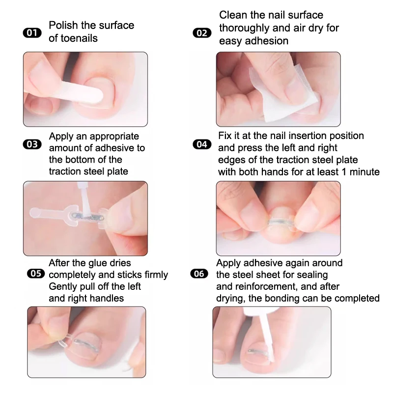 Nagelverzorging Ingegroeide teennagel Correctie Ingegroeide teen Nagelbehandeling Elastische patch Sticker Rechttrekken Clip Brace Pedicure Tool