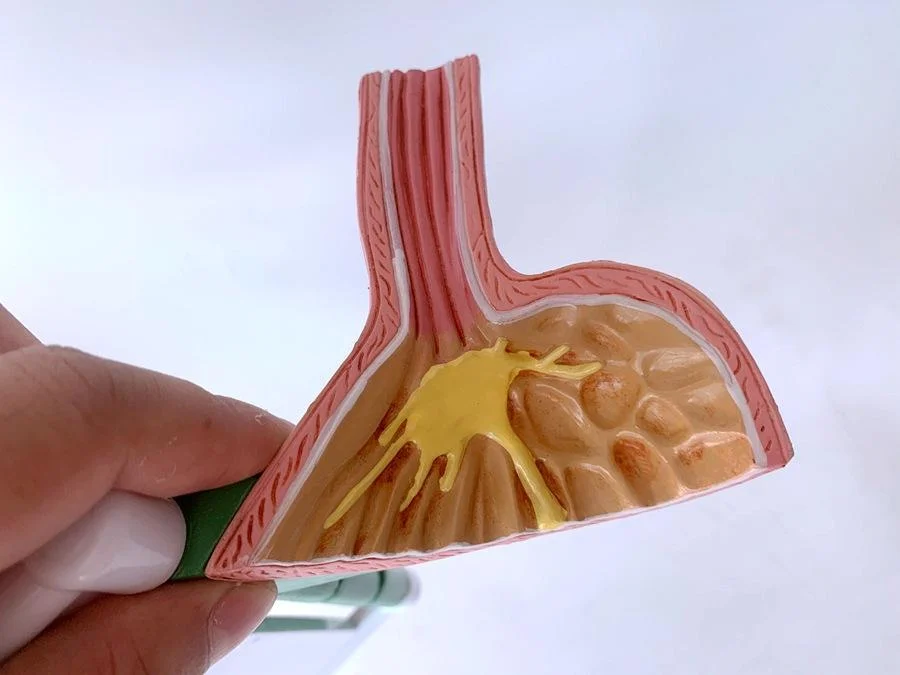Medical teaching anatomy human pathological lesions gastropathy model visceral structure experiment