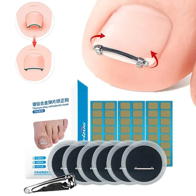 Strumento per pedicure dell'unghia del piede incarnita incorporato Cura delle unghie dei piedi Raddrizzamento Clip di correzione Morsetto curvo Strumento di correzione delle unghie dei piedi per le dita dei piedi