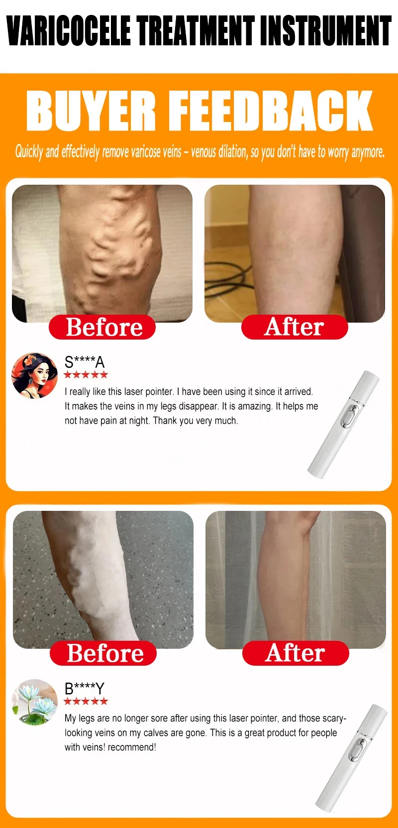 Varicose Vein Lampshade Therapy Effective Improved Blood Circulation Relief Of Dilated Vasculitis In The Legs Phlebitis New